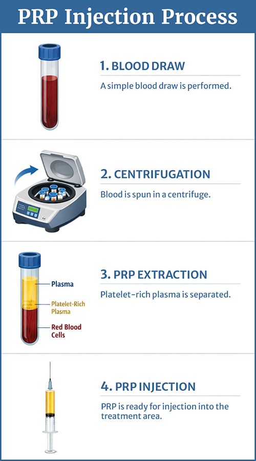 Platelet-Rich Plasma (PRP) Injection Process